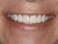 After Image: Porcelain Veneers - other