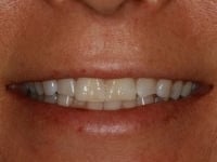 Before Image: Porcelain Veneers - other