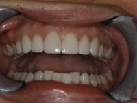 After Image: Porcelain Veneers - other