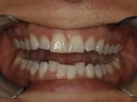 Before Image: Porcelain Veneers - other