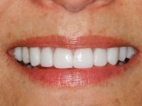 After Image: Porcelain Veneers - other