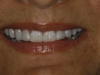 Before Image: Porcelain Veneers - other