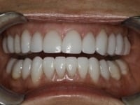 After Image: Porcelain Veneers - other
