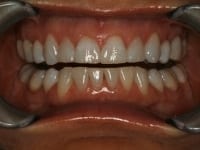 Before Image: Porcelain Veneers - other