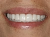 After Image: Porcelain Veneers - other