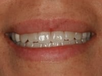 Before Image: Porcelain Veneers - other