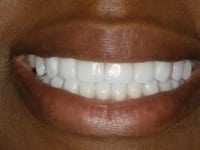 After Image: Porcelain Veneers - other