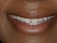 Before Image: Porcelain Veneers - other