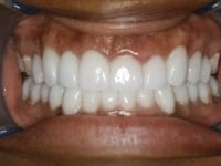 After Image: Porcelain Veneers - other