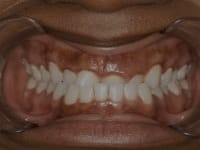 Before Image: Porcelain Veneers - other