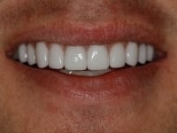 After Image: Porcelain Veneers - other