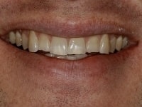 Before Image: Porcelain Veneers - other