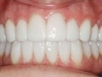 After Image: Porcelain Veneers - front