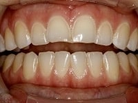Before Image: Porcelain Veneers - front