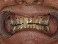 Full Mouth Rejuvenation