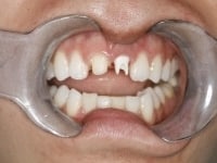 Before Image: Dental Implants - other