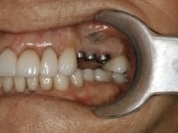 Dental Implants