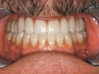 TMJ Dysfunction Treatment