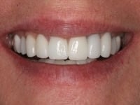 Dental Crowns and Bridges