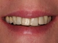 Dental Crowns and Bridges