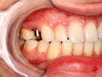 Dental Crowns and Bridges