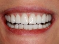 Dental Crowns and Bridges