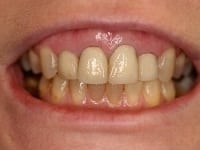 Dental Crowns and Bridges