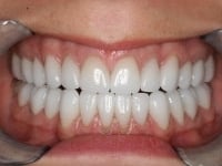 Dental Crowns and Bridges