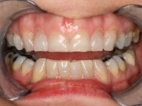 Dental Crowns and Bridges