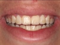 Dental Crowns and Bridges