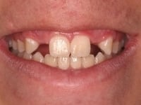 Dental Crowns and Bridges