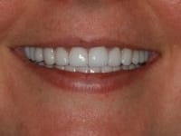 Dental Crowns and Bridges