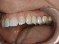 Dental Crowns and Bridges