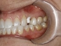 Dental Crowns and Bridges