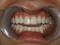 Dental Crowns and Bridges