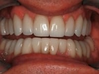 Dental Crowns and Bridges