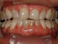 Dental Crowns and Bridges