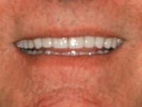 Dental Crowns and Bridges