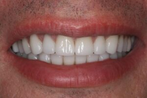 Smile Makeover – Case 1