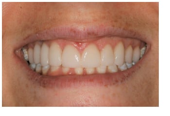 Gum Lift and Porcelain Veneers Combined with a Dental Implant