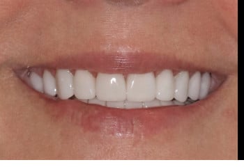 After Image: Worn Teeth and Misaligned Bite - front