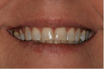 Before Image: Worn Teeth and Misaligned Bite - front