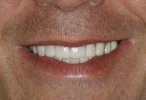 Can Porcelain Veneers Correct Spaces and Severely Stained Teeth?