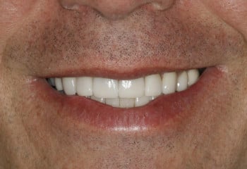After Image: Can Porcelain Veneers Correct Spaces and Severely Stained Teeth? - front