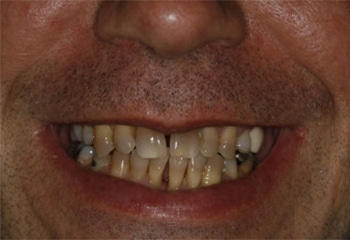 Before Image: Can Porcelain Veneers Correct Spaces and Severely Stained Teeth? - front