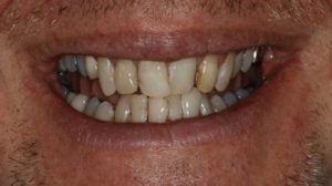 Non-surgical Overbite Correction and TMJ Pain Treatment