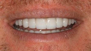 Non-surgical Overbite Correction and TMJ Pain Treatment