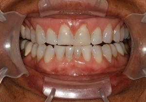 Life Changing Smiles With Custom Designed Porcelain Veneers