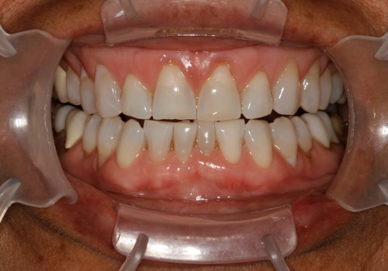 Before Image: Life Changing Smiles With Custom Designed Porcelain Veneers - front