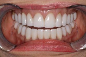 Teeth with full smile makeover to fix overbite. No more TMJ pain.